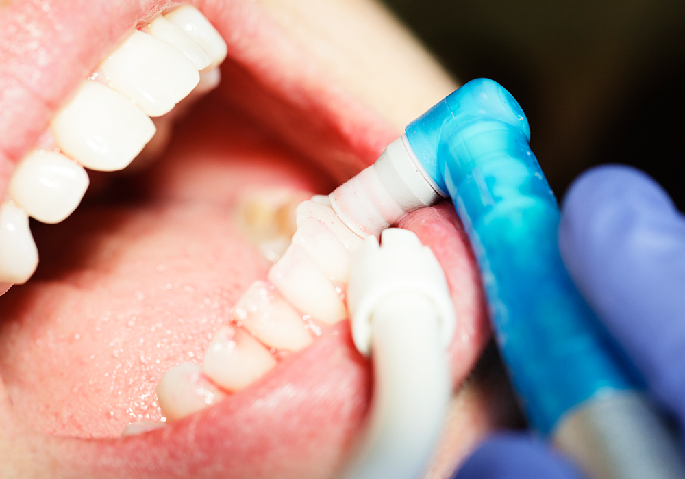 予防・クリーニング